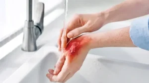 পোড়াজনিত জটিলতা প্রতিরোধ ও সঠিক পথে চিকিৎসা